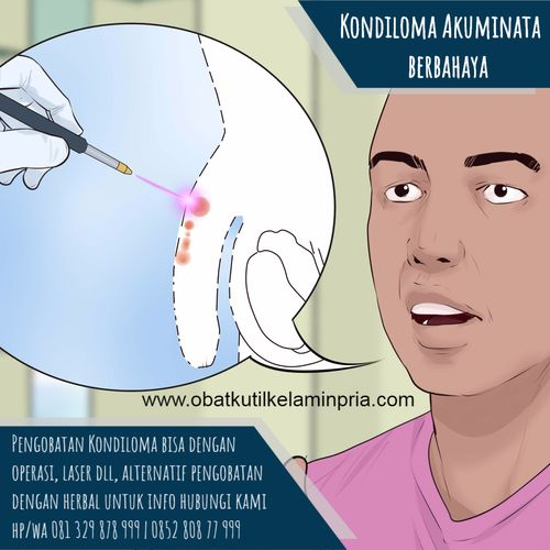 PENGOBATAN KUTIL KELAMIN SECARA ALAMI DENGAN BAWANG PUTIH