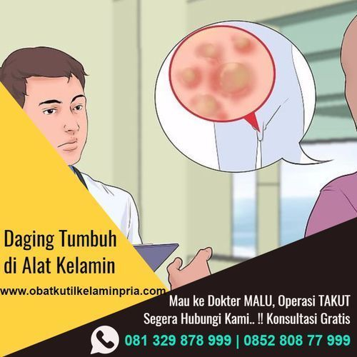 CARA MENYEMBUHKAN KUTIL KELAMIN DENGAN BUMBU DAPUR BAWANG PUTIH