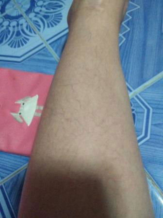 เส้นเลือดขอด