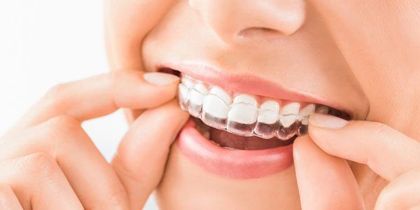 Mouthguards Melbourne