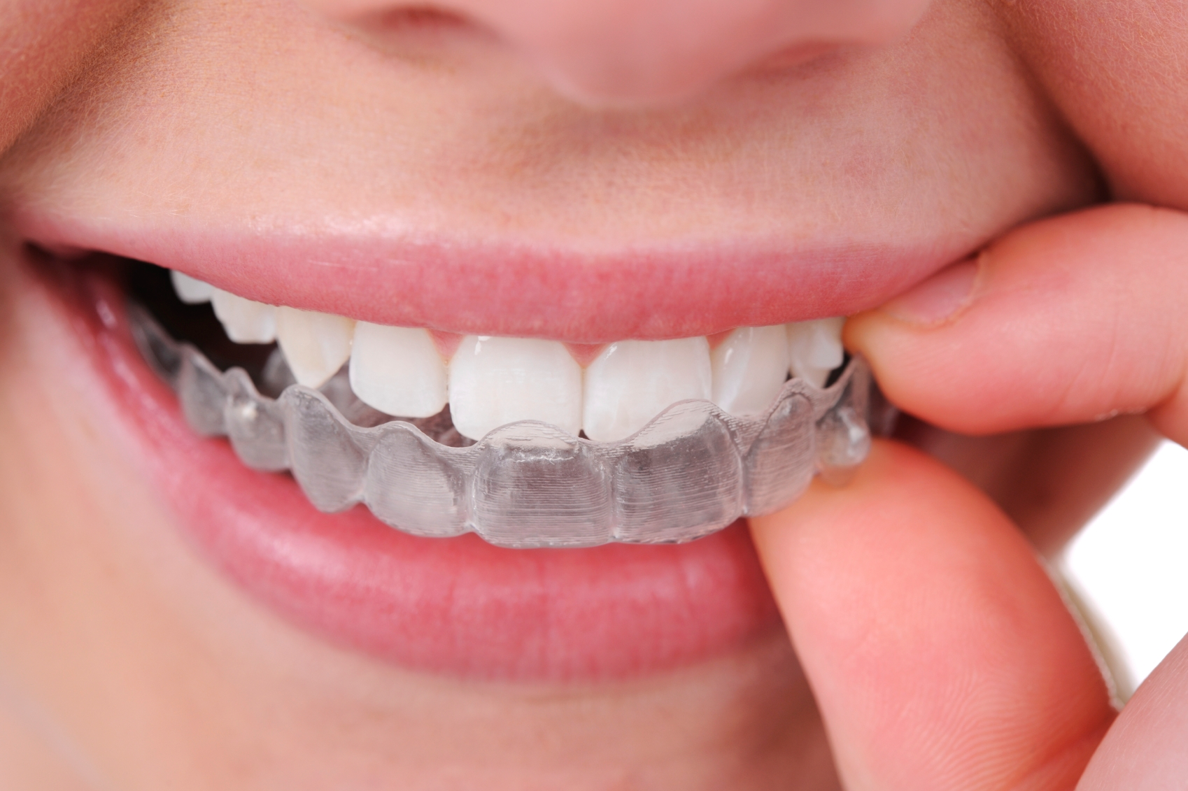 Mouthguards Melbourne
