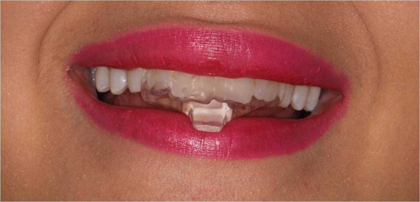 Mouthguards Melbourne