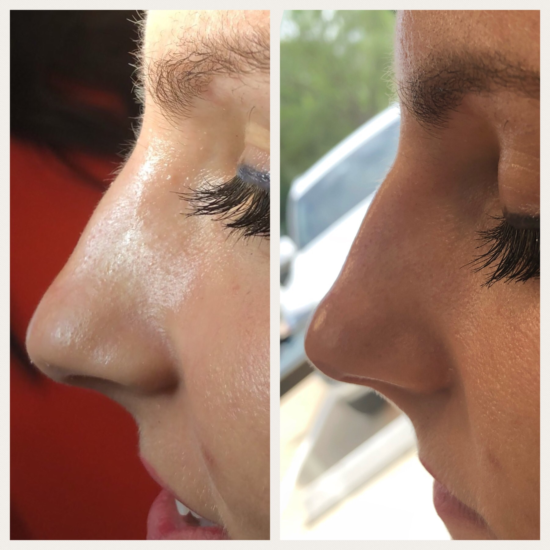 Non-surgical-rhinoplasty-Juvederm-Vollure1-1