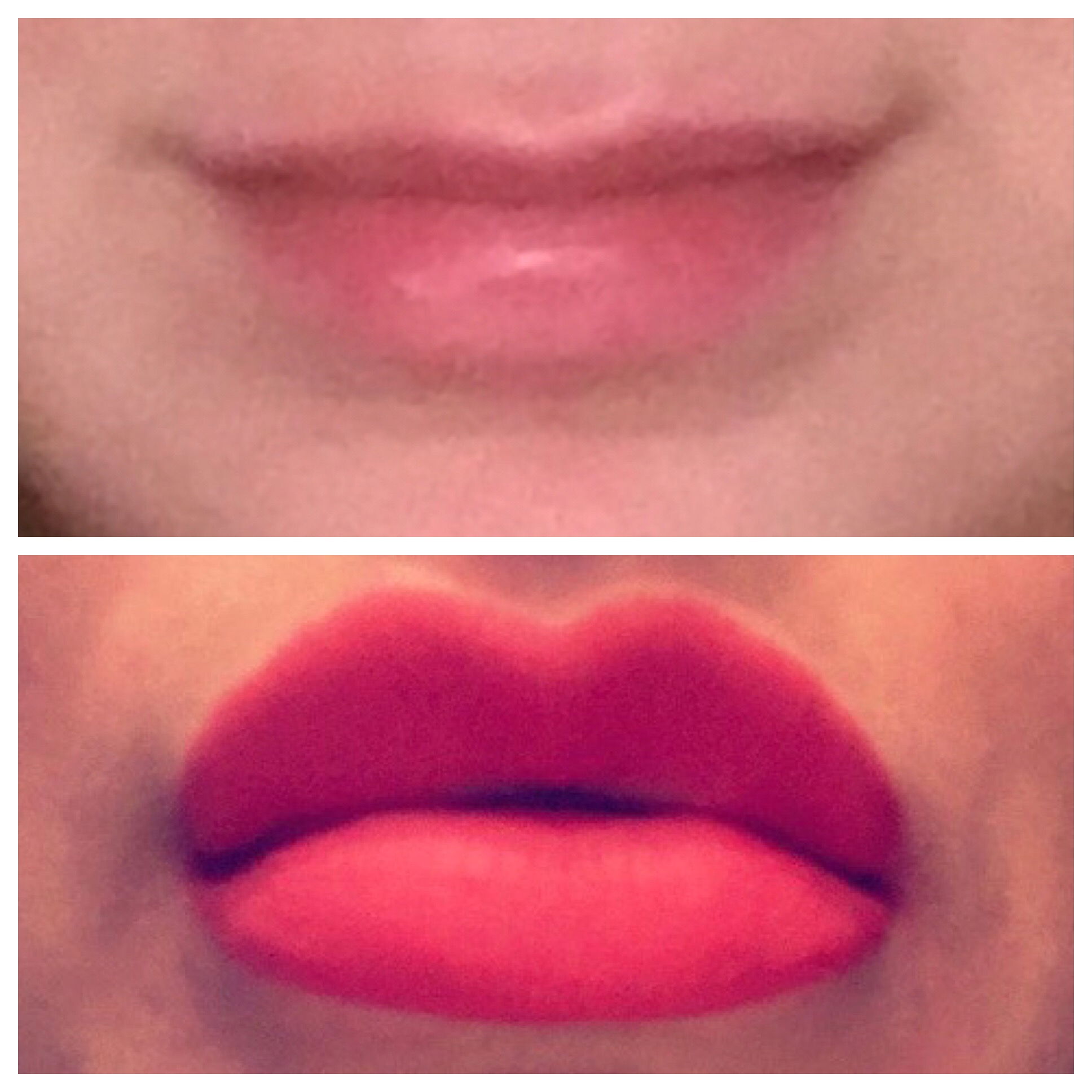 Lips-before-and-after-Juvederm-Ultra4-1