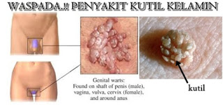 obat daging tumbuh di vagina paling manjur