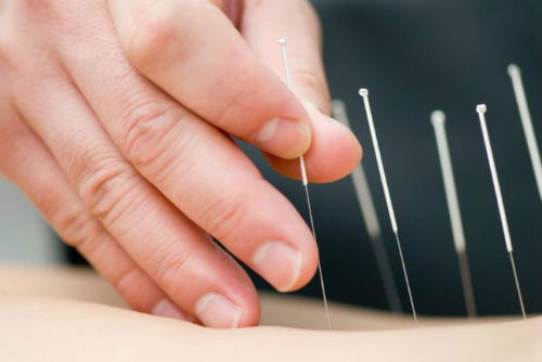 Châm cứu bấm huyệt trị đau thần kinh tọa 2 bên