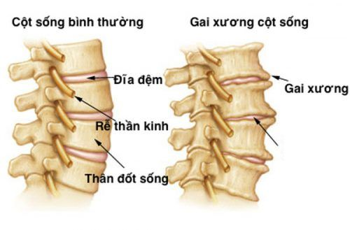 Bệnh gai cột sống
