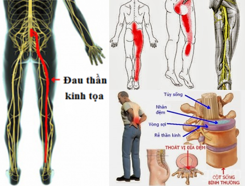 Káº¿t quáº£ hÃ¬nh áº£nh cho Äau tháº§n kinh tá»a á» ngÆ°á»i tráº» tuá»i