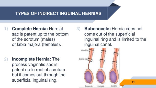 superficial inguinal ring palpation