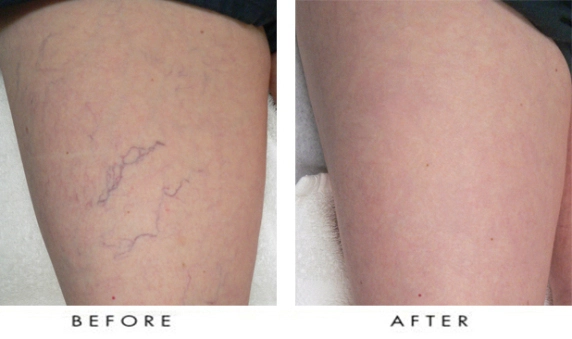 Laser Spider Vein Removal.jpg