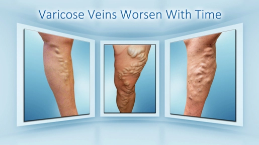 Varicose Vein Disease.jpg