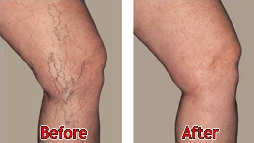 Spider Veins Remedy.jpg