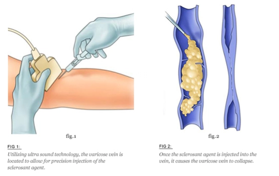 Sclerotherapy Procedure.jpg