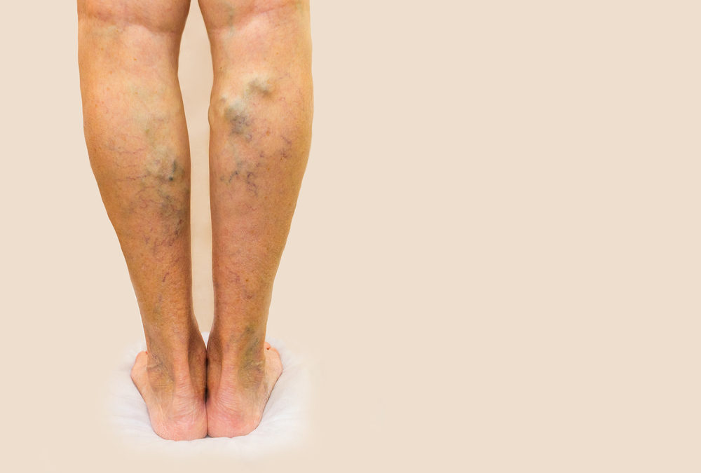 Vein Disease in Legs.jpg