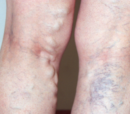 vein disease in legs