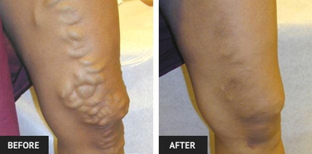 Laser Varicose Vein Removal