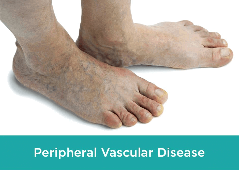 Peripheral Vein Disease