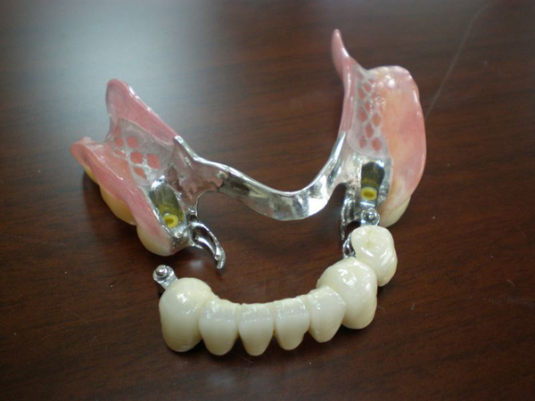 Dùng hàm giả tháo lắp là cách trồng răng giả đơn giản, tiết kiệm chi phí