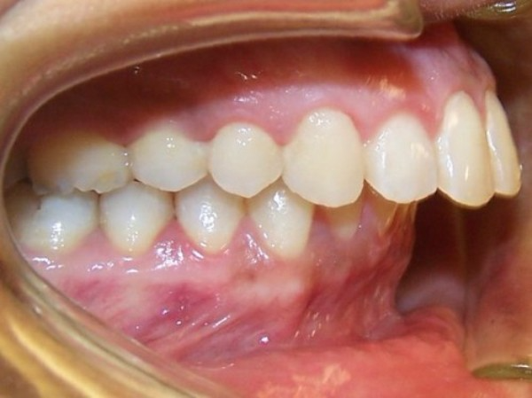 xác định răng hô là thế nào