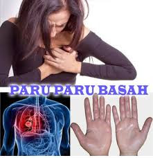 nama obat tbc paru-paru basah di apotik yang ampuh