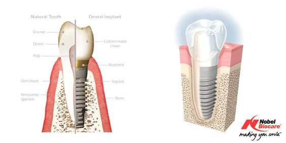 c3217802883d3caa3a12fbcca28dd5f5--denture-dental-implants