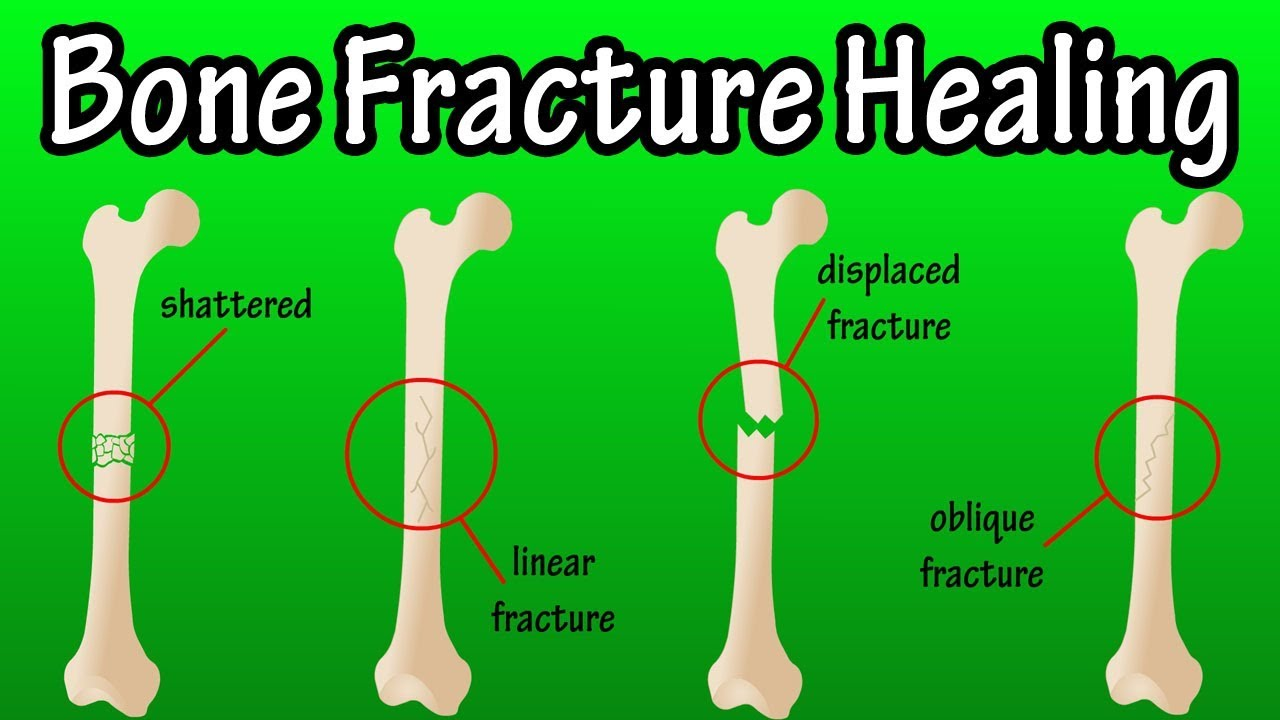 Fracture Surgery In Ahmedabad 