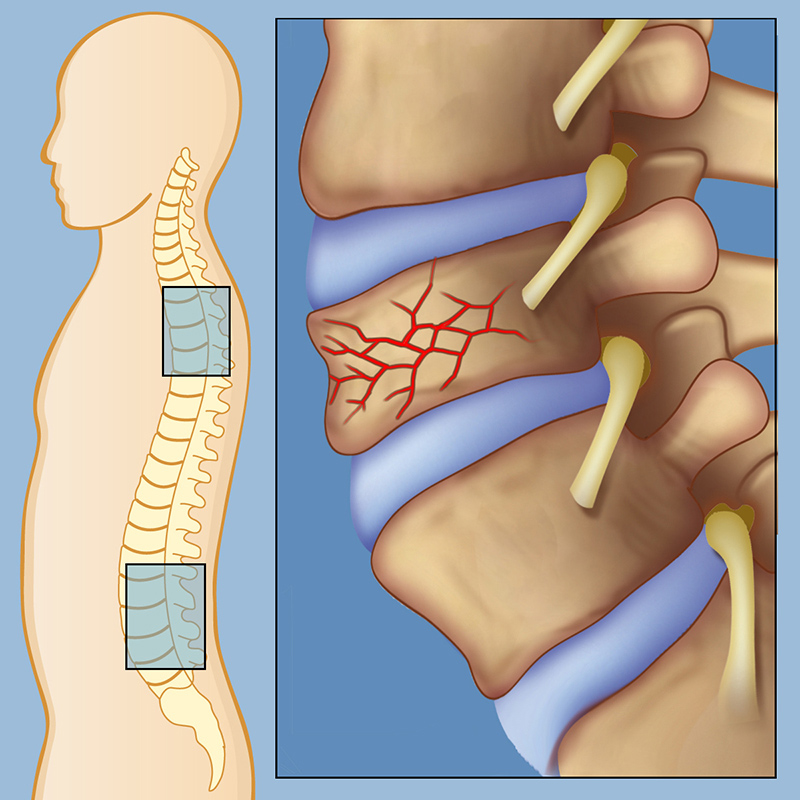 Fracture Surgery In Ahmedabad