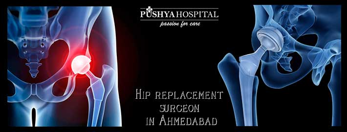 Hip Replacement Surgeon in Ahmedabad