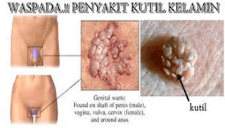 https://www.apotikdenature.com/2018/02/obat-hpv-kutil-kelamin-paling-ampuh.html