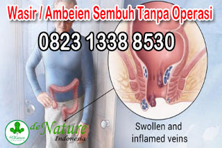 Alternatif Alami Terampuh Mengobati Ambeien Sembuh Total Tanpa Operasi