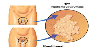 https://www.apotikdenature.com/2018/03/resep-obat-kondiloma-tanpa-operasi-di.html