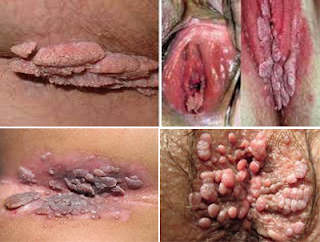 https://www.apotikdenature.com/2018/03/obat-kutil-kelamin-di-memek-atau-vagina.html