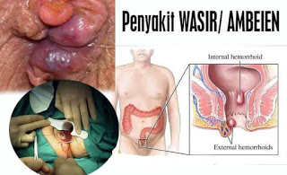 https://sediaobatwasir.blogspot.com/2019/08/cara-ampuh-menyembuhkan-iritasi-dubur.html