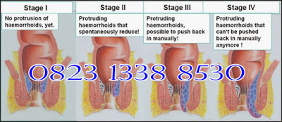 https://sediaobatwasir.blogspot.com/2019/09/merk-obat-wasir-paling-manjur-terbukti.html