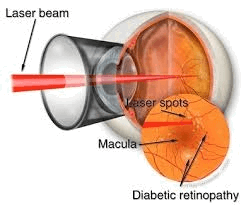 How a laser surgery is performed?