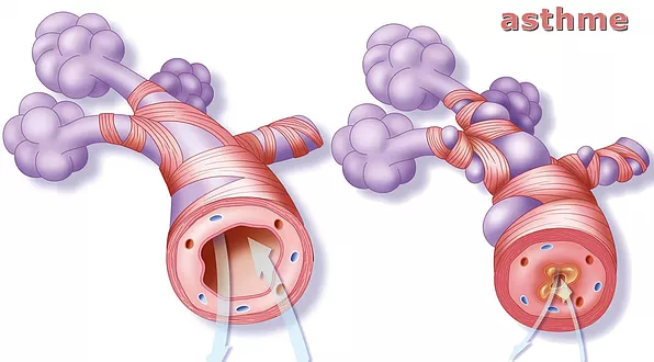 asthme-bronches.jpg