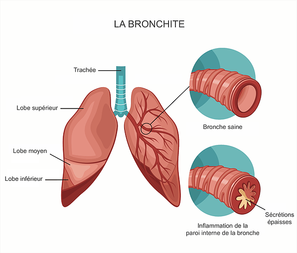 Bronchite.png