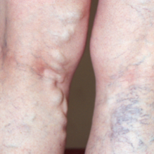 vein-disease-in-legs