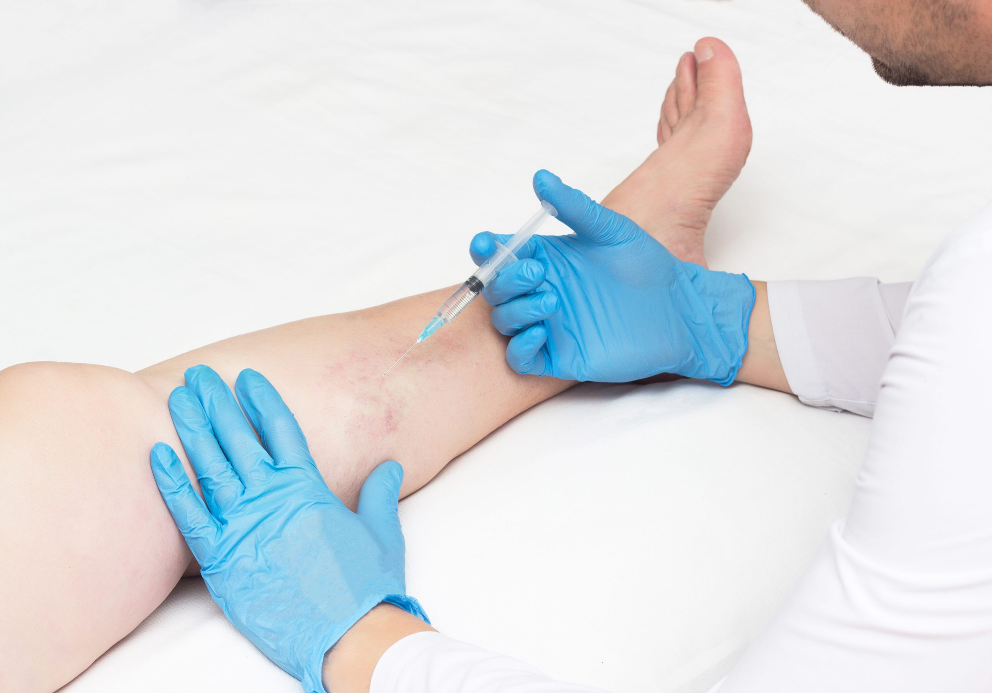 Copy-of-Sclerotherapy-shutterstock_1283406964-scaled.jpg