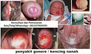 bahaya kencing nanah jika tidak diobati