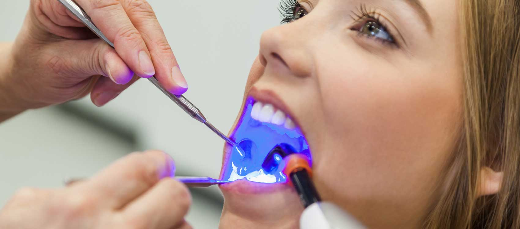 Teeth-Whitening-Richmond-Dental-PLLC