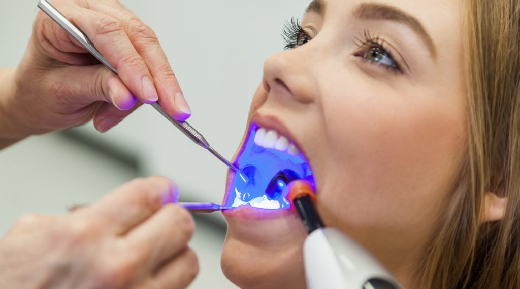 Tooth-Colored-Fillings-in-Clute-texas-1024x571