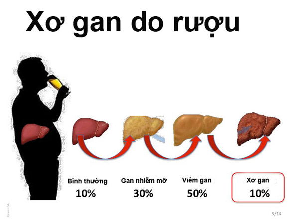 Viêm gan do uống rượu