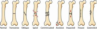 Image result for types of fractures