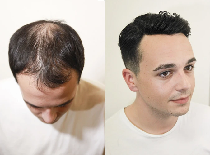 hair replacement systems