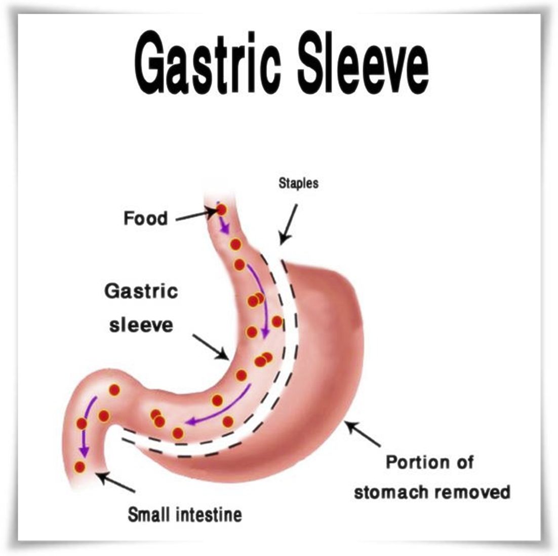 gastric sleeve Melbourne