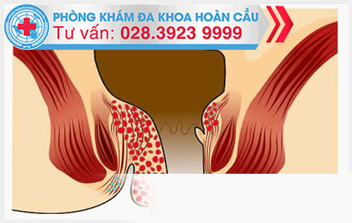 Bệnh trĩ nội cấp độ 3 và cách điều trị hiệu quả là gì?