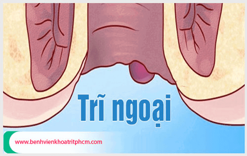 Trĩ ngoại độ 3 là như thế nào và cách điều trị dứt điểm?