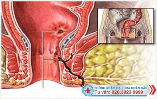 Có nhiều nguyên nhân gây tình trạng rò hậu môn