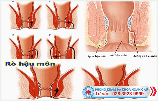 Cần phải kịp thời điều trị rò hậu môn